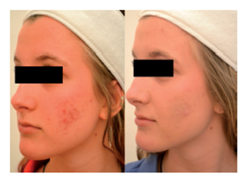 Acne Cleared with LED Light Therapy